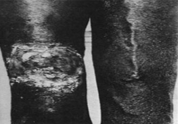 زخم ایجادشده بر بدن فرد مورد آزمایش با باکتری سیفلیس