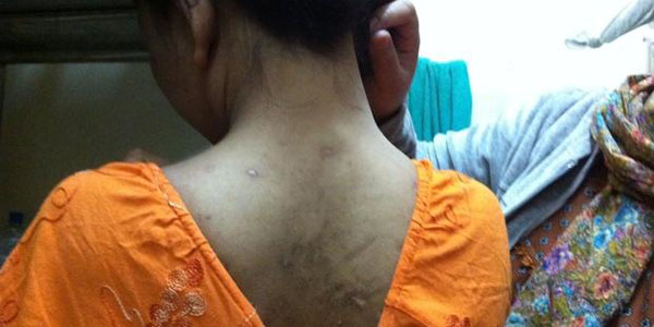 دختر اندونیزیایی که مورد خشونت توسط کارفرمایش در قطر قرار گرفته‌است. (عکس از: سازمان «عفو بین‌الملل»)